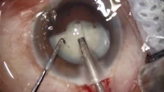 White Cataract Phaco emulsification 4k Dr Deepak Megur [upl. by Lidaa]