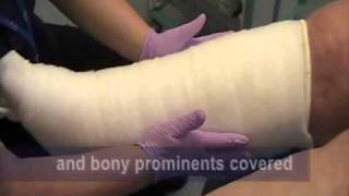 Correct way to apply toe and multilayer bandaging to Lymphoedema patients [upl. by Aspa551]