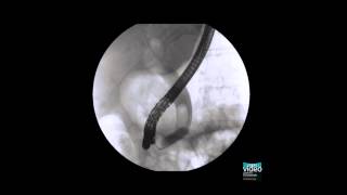 Endoscopic partial sphincterotomy coupled with large balloon papilla dilation [upl. by Imoyn]