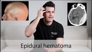 Epidural Hematoma \\ everything you need to know [upl. by Nolur]