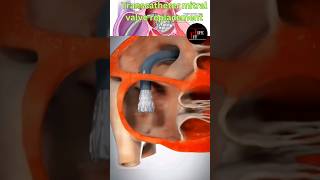 3D Transcatheter mitral valve replacement😱😲💯 demonstration heart health 3d shorts [upl. by Dreeda]