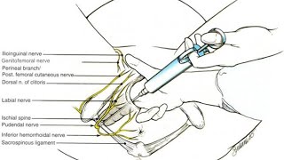 Best location to deliver anaesthetic to perform pudendal nerve block [upl. by Nyllek]