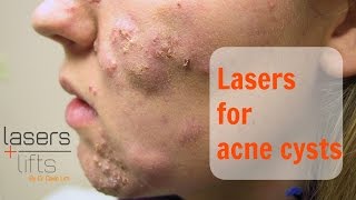 Treating acne cysts [upl. by Citarella672]