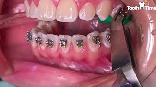 How they put braces on  13 years old patient  Tooth Time Family Dentistry New Braunfels Texas [upl. by Jojo]