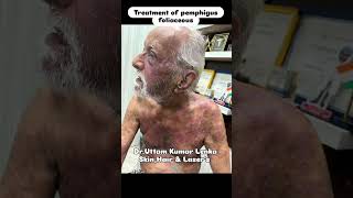 Pemphigus foliaceous treatment skin peel disease [upl. by Ecnerwal]