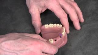 Straumann Implant Level Impressions [upl. by Bette]