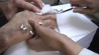 Kwire Removal from Healed Hand [upl. by Yborian]