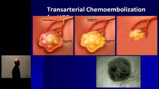 Hepatocellular Carcinoma Optimal Treatment and Transplantation [upl. by Ikcin846]