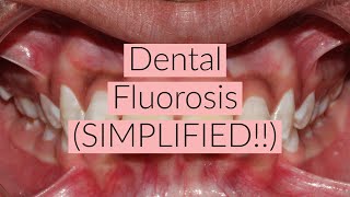 Dental Fluorosis SIMPLIFIED [upl. by Nalo772]