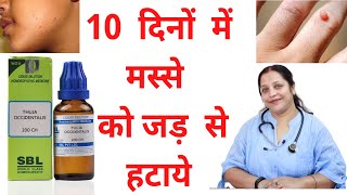 Warts homeopathic medicine  मस्से का इलाज  Homeopathic medicine for warts  warts ka ilaj [upl. by Anicnarf394]