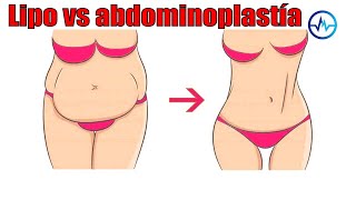 DIFERENCIAS entre ABDOMINOPLASTÍA y LIPOSUCCIÓN 🌹 DR ALBERTO CALVO 👸 MEDICINA EXTRAORDINARIA [upl. by Hagile]