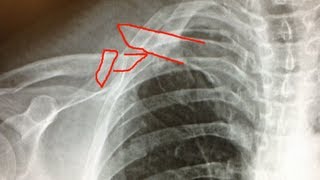 Clinical Case Clavicle Fracture [upl. by Ahouh]