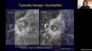 Breast Imaging Calcifications  module 2  Health4TheWorld Academy [upl. by Buonomo]