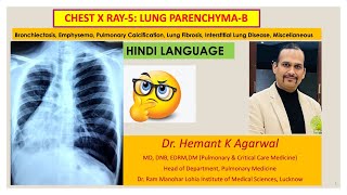 Radiology Chest X Ray5 HINDI Bronchiectasis Emphysema ILD Pulmonary Edema NoduleDr Hemant [upl. by Ynaffet]