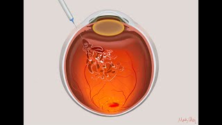 AntiVEGF intravitreal injection [upl. by Yniattirb]