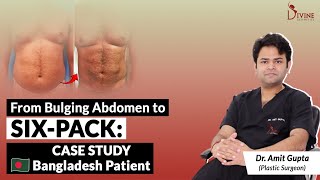 From Bulging Abdomen to SixPack Case Study Bangladesh Patient  Dr Amit Gupta [upl. by Dulsea609]