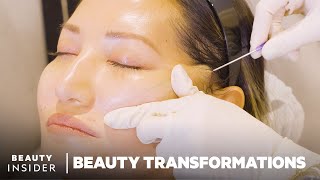 How Nonsurgical FaceLifts Work With PDO Threads  Beauty Transformations  Insider Beauty [upl. by Heeley]