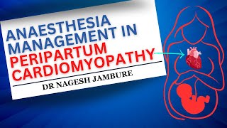 Anaesthesia Management In Peripartum Cardiomyopathy I Dr Nagesh Jambure [upl. by Powel]