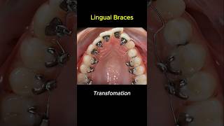 Lingual braces transformation braces orthodontist bracket [upl. by Aron]