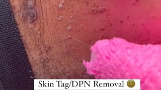 Skin Tag Removal or Dermatosis Papulosa Nigra DPN Removal [upl. by Alyl]