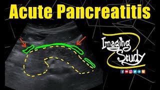 Acute Pancreatitis  Ultrasound  Case 303 [upl. by Sordnaxela]