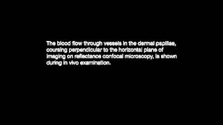 The Vasculature of Nonmelanocytic Skin Tumors on Reflectance Confocal Microscopy Vascular Features [upl. by Odnalref319]