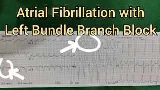 Atrial Fibrillation with Left Bundle Branch Block on ECG [upl. by Zaller]