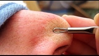 3A of 4 Removing Blackheads amp Whiteheads Using A Comedone Extractor Tool HD [upl. by Enavi512]