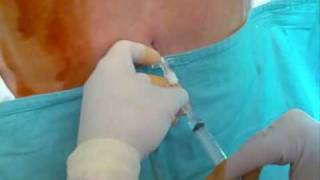 CSE combined spinal epidural anaesthesia needle to needle tecnique [upl. by Beverle]