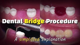 Dental Bridge Procedure [upl. by Oderfliw]