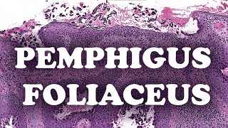 LE PEMPHIGUS FOLIACE  PATHOLOGIE [upl. by Leohcin]