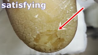 Cracked heels treatment amp Callus removal  Dead skin removal and Cracked heels treatment part 2 [upl. by Fox998]