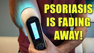 Psoriasis UVB Light  60 days in  The Results [upl. by Allerie427]