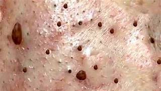 Blackheads amp Whiteheads Satisfying Removal 0118 blackhead new [upl. by Esekram]