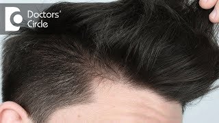 What causes hair loss in teenage boys with parents having good hair  Dr Rashmi Ravindra [upl. by Freed]