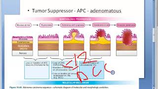 Pathology 521 h AdenoCarcinoma Colon sequence colorectal cancer tumor mutation DCC genetics [upl. by Htenek]