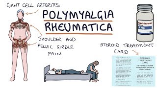 Polymyalgia Rheumatica Visual Explanation for Students [upl. by Yemrej664]