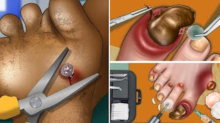 ASMR Toenail Treatment  Screw nail removal [upl. by Briggs]