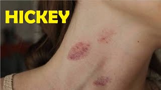 fast way to give someone a hickey tutorial [upl. by Lampert]