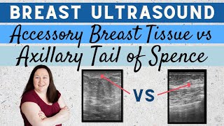 Breast Ultrasound  Accessory Breast Tissue vs Axillary Tail of Spence [upl. by Meeharbi]