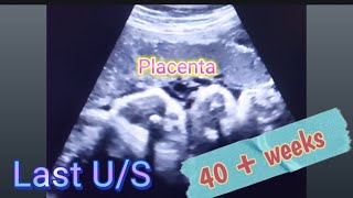 Baby BOY placenta position gender prediction  Anterior Placenta baby gender  how to reveal gender [upl. by Braunstein144]