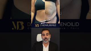 AvantAprès Abdominoplastie ✨ [upl. by Robi]