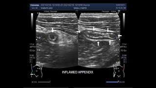 The scanning and localization of Acute Appendicitis [upl. by Colby]