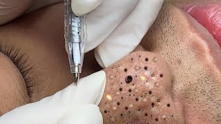 Blackheads amp Acne Treatment 01052024 Part 3 [upl. by Ivetts948]