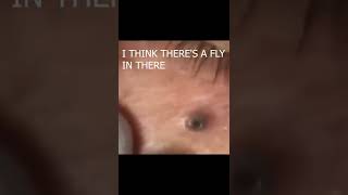 pimple popping 2022 new blackheads on nose very large blackheadsshortspoppingacne [upl. by Atwekk192]