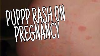 WHAT IS PUPPP  HOW TO TREAT PUPPP RASH ON PREGNANCY IN NATURAL WAYS [upl. by Asilla]