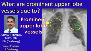 What are prominent upper lobe vessels due to [upl. by Notlit711]