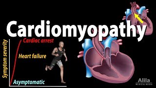 Cardiomyopathy animation [upl. by Sanoy]