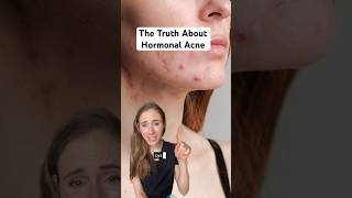 Hormonal Acne Is A Mixed Bag  Heres What You Need To Know dermatologist [upl. by Ayotna]