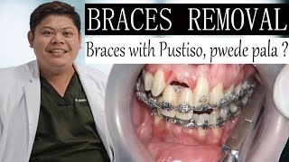 Braces with Pustiso pwede ba TARA at ALAMIN  BRACES REMOVAL  Doc Noy [upl. by Borries]